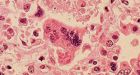As many as 100 kids in Fraser Valley, B.C. may have measles | CTV News